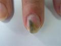 NAIL DISEASES - Pseudomonas aeruginosa infection of the nail