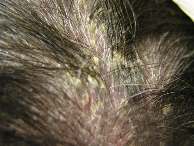 HAIR DISEASES - Pityriasis amiantacea
