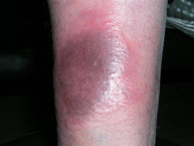 DISEASE OF THE BLOOD AND THE VESSELS – PURPURAS - Acroangiodermatitis (Pseudo-Kaposi Sarcoma) DISEASE OF THE BLOOD AND THE VESSELS – PURPURAS - Acroangiodermatitis (Pseudo-Kaposi Sarcoma)