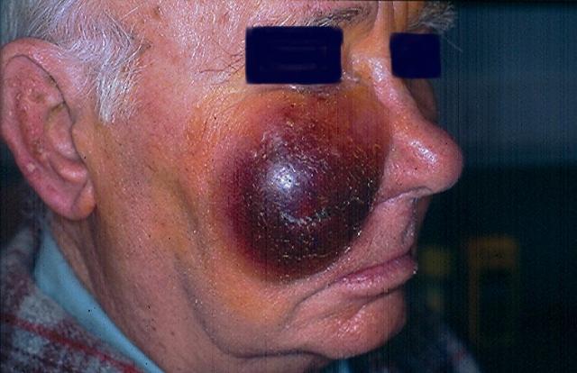 LYMPHOMAS - LYMPHOCYTIC INFILTRATIONS - Mycosis Fungoides