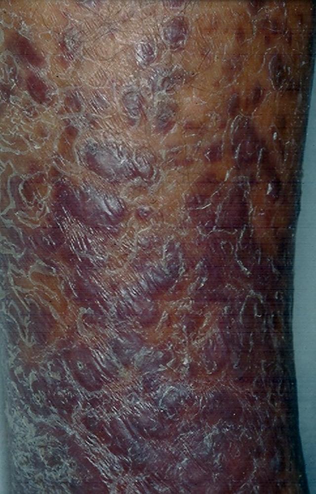 DISEASE OF THE BLOOD AND THE VESSELS – PURPURAS - Acroangiodermatitis (Pseudo-Kaposi Sarcoma)