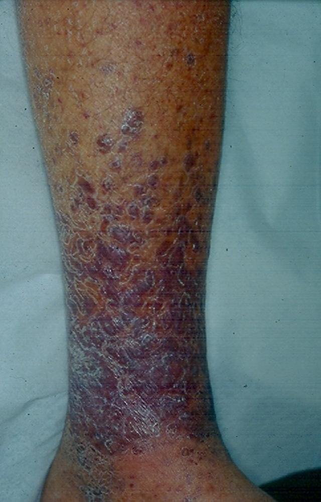 DISEASE OF THE BLOOD AND THE VESSELS – PURPURAS - Acroangiodermatitis (Pseudo-Kaposi Sarcoma)