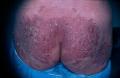 SYPHILIS AND OTHER SEXUAL TRANSMITTED DISEASES - Reiter