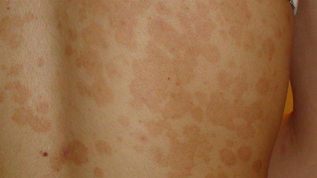 SUPERFICIAL FUNGAL INFECTIONS - Pityriasis versicolor