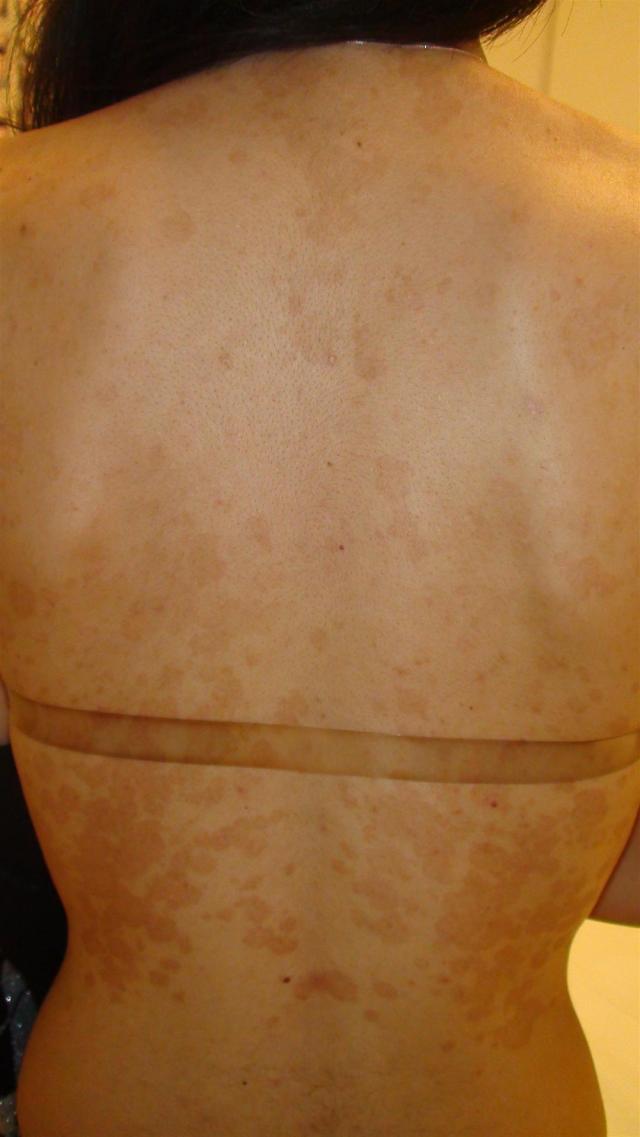 SUPERFICIAL FUNGAL INFECTIONS - Pityriasis versicolor