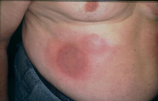 DISEASE OF THE BLOOD AND THE VESSELS – PURPURAS - Eosinophilic Cellulitis (Wells Syndrome)