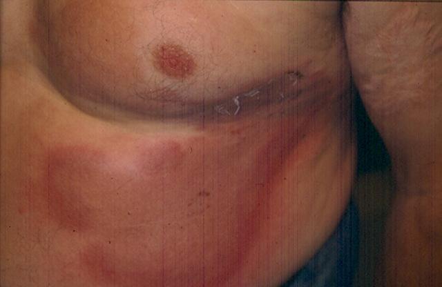 DISEASE OF THE BLOOD AND THE VESSELS – PURPURAS - Eosinophilic Cellulitis (Wells Syndrome)