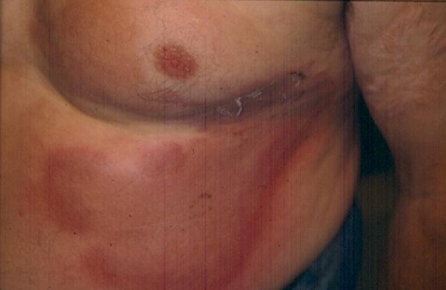 DISEASE OF THE BLOOD AND THE VESSELS – PURPURAS - Eosinophilic Cellulitis (Wells Syndrome) DISEASE OF THE BLOOD AND THE VESSELS – PURPURAS - Eosinophilic Cellulitis (Wells Syndrome)