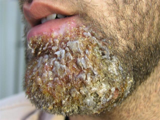 BACTERIAL INFECTIONS - Sycosis due to Serratia BACTERIAL INFECTIONS - Sycosis due to Serratia