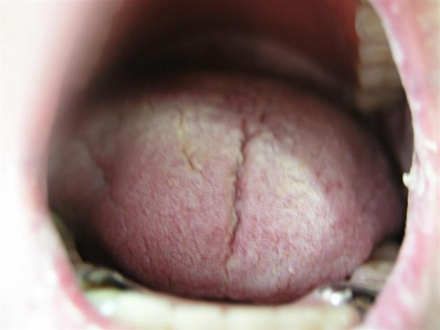 MUCOSAL LESIONS - Candidiasis, oral