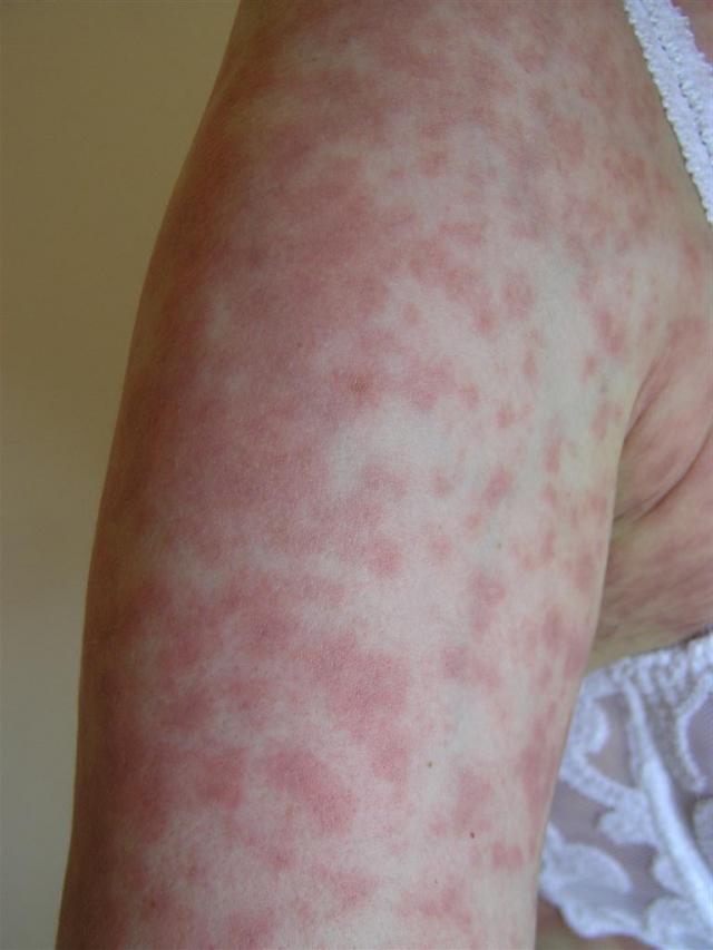 VIRAL INFECTIONS - Epstein - Barr infection
