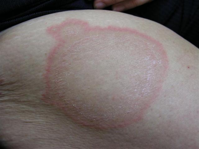 VARIOUS or of UNKNOWN ETIOLOGY DISEASES - Erythema Annulare Centifigum