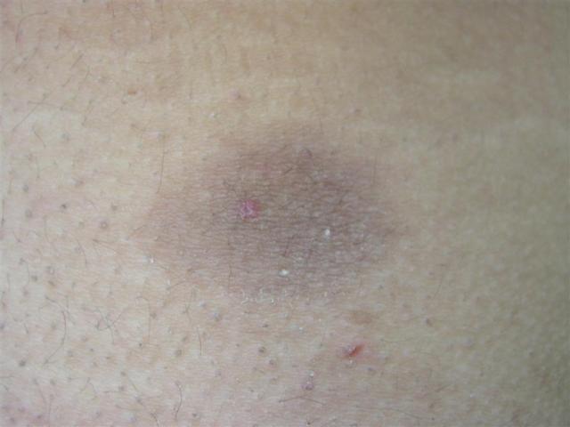 DRUG ERUPTIONS - Fixed drug eruption DRUG ERUPTIONS - Fixed drug eruption