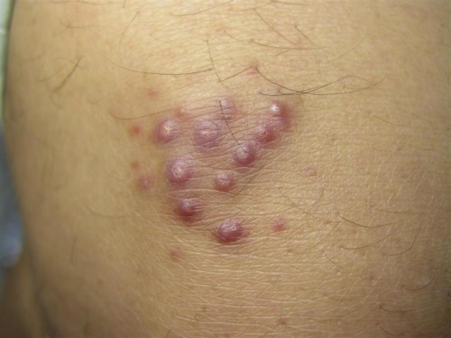 VARIOUS or of UNKNOWN ETIOLOGY DISEASES - Sea Urchin Granuloma