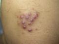 VARIOUS or of UNKNOWN ETIOLOGY DISEASES - Sea Urchin Granuloma
