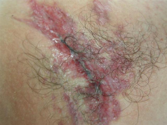 DISEASES OF THE SEBACEOUS GLANDS - Hidradenitis Suppurativa DISEASES OF THE SEBACEOUS GLANDS - Hidradenitis Suppurativa