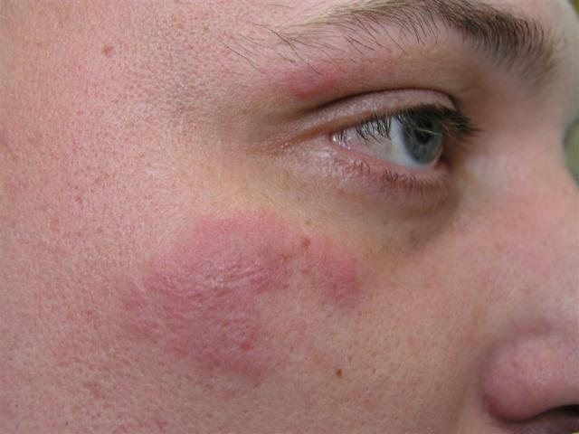 LYMPHOMAS - LYMPHOCYTIC INFILTRATIONS - Lymphocytic Infiltration of the skin (Jessner) LYMPHOMAS - LYMPHOCYTIC INFILTRATIONS - Lymphocytic Infiltration of the skin (Jessner)