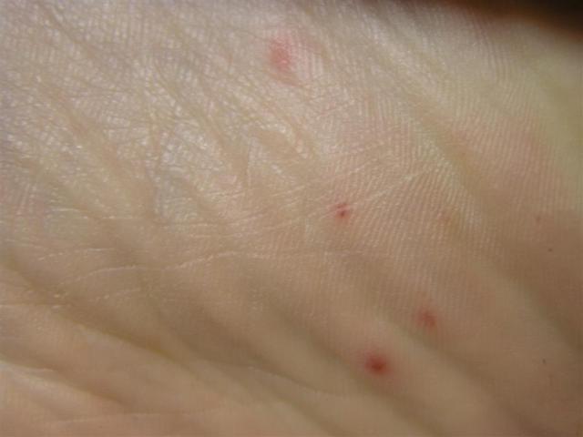 VARIOUS or of UNKNOWN ETIOLOGY DISEASES - Pityriasis lichenoides et varioliformis acuta VARIOUS or of UNKNOWN ETIOLOGY DISEASES - Pityriasis lichenoides et varioliformis acuta