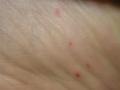 VARIOUS or of UNKNOWN ETIOLOGY DISEASES - Pityriasis lichenoides et varioliformis acuta