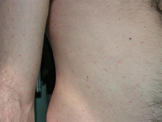 VARIOUS or of UNKNOWN ETIOLOGY DISEASES - Pityriasis lichenoides et varioliformis acuta