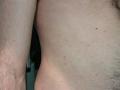 VARIOUS or of UNKNOWN ETIOLOGY DISEASES - Pityriasis lichenoides et varioliformis acuta