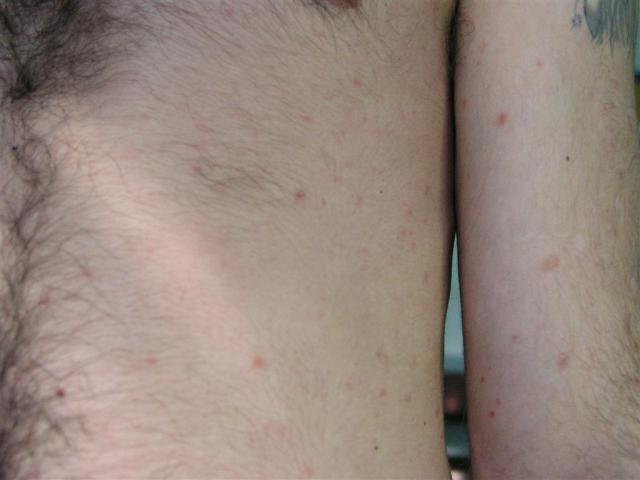 VARIOUS or of UNKNOWN ETIOLOGY DISEASES - Pityriasis lichenoides et varioliformis acuta VARIOUS or of UNKNOWN ETIOLOGY DISEASES - Pityriasis lichenoides et varioliformis acuta