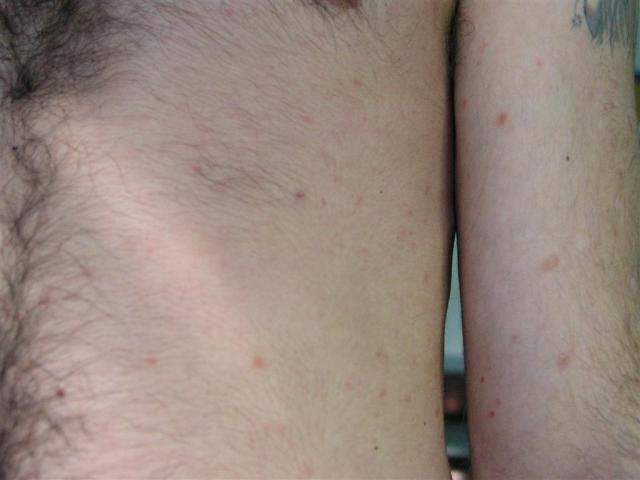 VARIOUS or of UNKNOWN ETIOLOGY DISEASES - Pityriasis lichenoides et varioliformis acuta