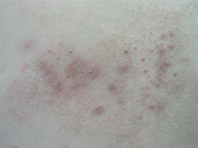 KERATINISATION DISORDERS - Pityriasis rubra pilaris KERATINISATION DISORDERS - Pityriasis rubra pilaris