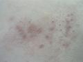 KERATINISATION DISORDERS - Pityriasis rubra pilaris