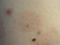 KERATINISATION DISORDERS - Pityriasis rubra pilaris