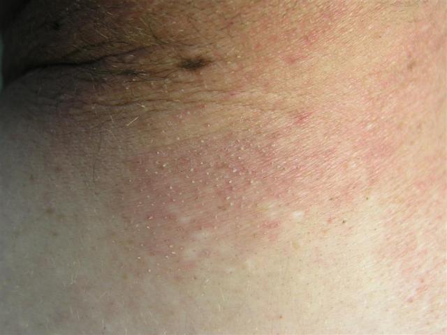 KERATINISATION DISORDERS - Pityriasis rubra pilaris