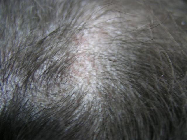 KERATINISATION DISORDERS - Pityriasis rubra pilaris