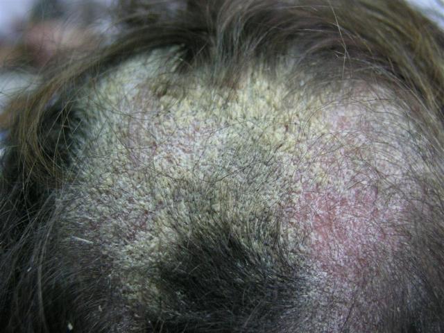 PSORIASIS - Psoriasis PSORIASIS - Psoriasis