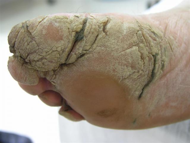 PSORIASIS - Psoriasis of the palms and soles (Keratoderma)