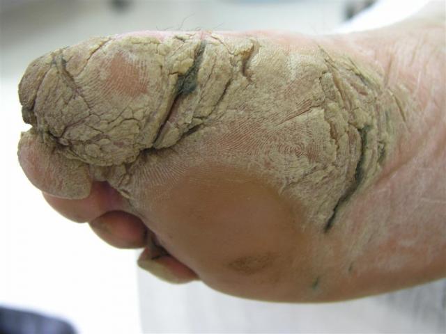 PSORIASIS - Psoriasis of the palms and soles (Keratoderma) PSORIASIS - Psoriasis of the palms and soles (Keratoderma)