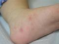 PARASITOSES, BITES - Scabies