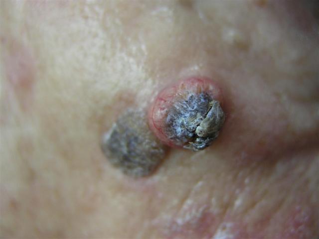 MALIGNANT LESIONS - Squamous Cell Carcinoma (SCC)