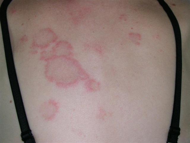 CONNECTIVE TISSUE DISORDERS - SCLE (Subacute Cutaneous Lupus Erythematosus)