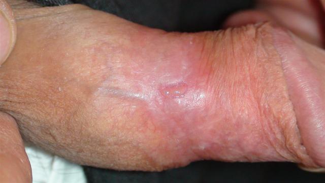 Hardin MD : Genital Herpes Pictures