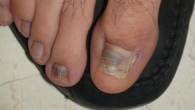 NAIL DISEASES - Onychomycosis