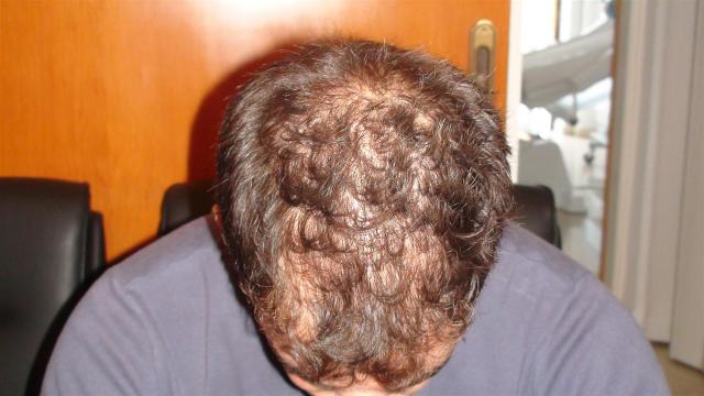HAIR DISEASES - Androgenetic alopecia HAIR DISEASES - Androgenetic alopecia