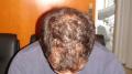 HAIR DISEASES - Androgenetic alopecia