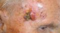 MALIGNANT LESIONS - Basal Cell Carcinoma