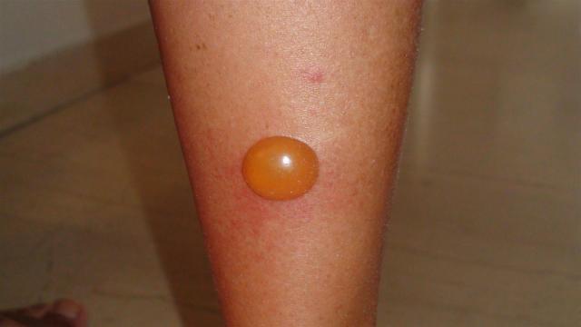 PARASITOSES BITES Bullous Insect Bites Picture Hellenic 