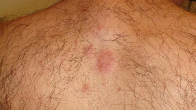 CONNECTIVE TISSUE DISORDERS - Discoid lupus erythematosus CONNECTIVE TISSUE DISORDERS - Discoid lupus erythematosus