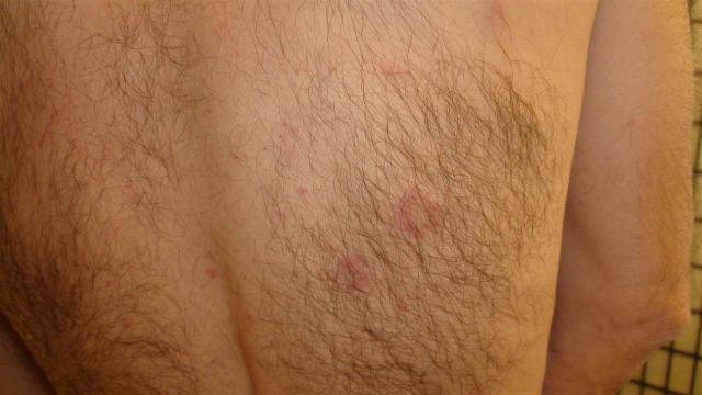 CONNECTIVE TISSUE DISORDERS - Discoid lupus erythematosus CONNECTIVE TISSUE DISORDERS - Discoid lupus erythematosus
