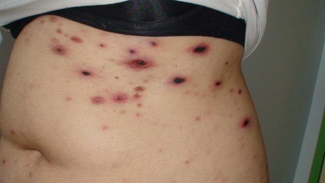 LYMPHOMAS - LYMPHOCYTIC INFILTRATIONS - Primary cutaneous CD8-positive epidermotropic cytotoxic T cell lymphoma LYMPHOMAS - LYMPHOCYTIC INFILTRATIONS - Primary cutaneous CD8-positive epidermotropic cytotoxic T cell lymphoma