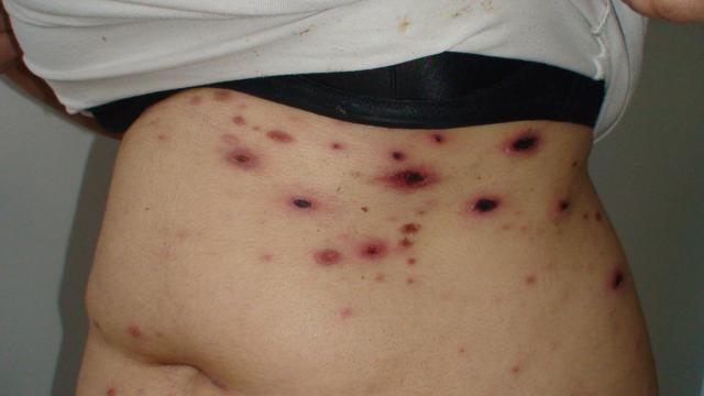 LYMPHOMAS - LYMPHOCYTIC INFILTRATIONS - Primary cutaneous CD8-positive epidermotropic cytotoxic T cell lymphoma LYMPHOMAS - LYMPHOCYTIC INFILTRATIONS - Primary cutaneous CD8-positive epidermotropic cytotoxic T cell lymphoma