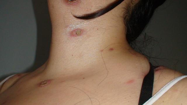 LYMPHOMAS - LYMPHOCYTIC INFILTRATIONS - Primary cutaneous CD8-positive epidermotropic cytotoxic T cell lymphoma LYMPHOMAS - LYMPHOCYTIC INFILTRATIONS - Primary cutaneous CD8-positive epidermotropic cytotoxic T cell lymphoma
