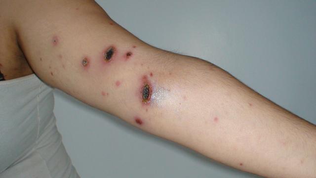 LYMPHOMAS - LYMPHOCYTIC INFILTRATIONS - Primary cutaneous CD8-positive epidermotropic cytotoxic T cell lymphoma LYMPHOMAS - LYMPHOCYTIC INFILTRATIONS - Primary cutaneous CD8-positive epidermotropic cytotoxic T cell lymphoma